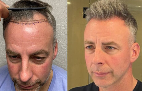 Male Hair Transplant Before & After