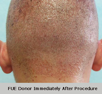 FUE Donor immediately after procedure