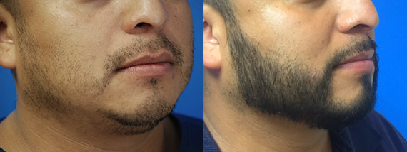Beard Restoration Before and After