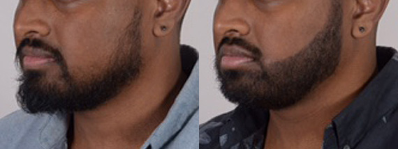 Beard Restoration Before and After