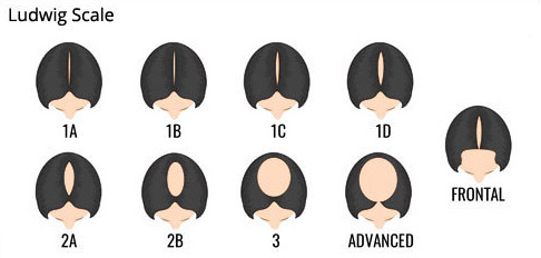 Katona - Ludwig Female Hair Loss Chart