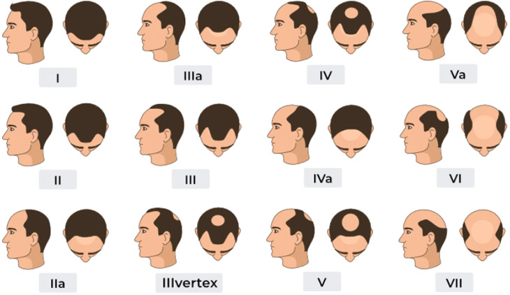 Katona - Norwood Male Hair Loss Chart