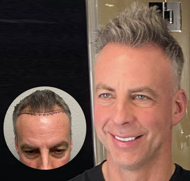 Before and After Hair Transplant Success Story