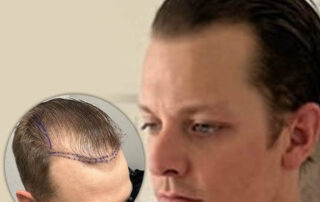 Before and After Hair Transplant Success Story