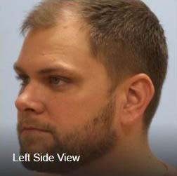profile view hair transplant photo