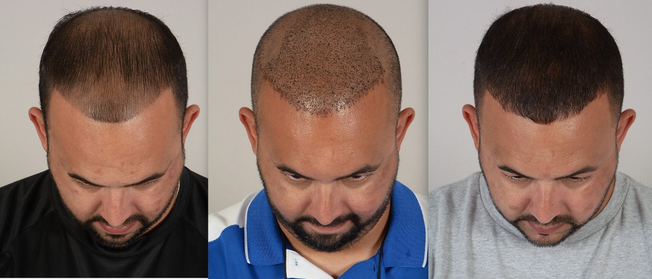 FUE Before, Immediate Post-Op and After