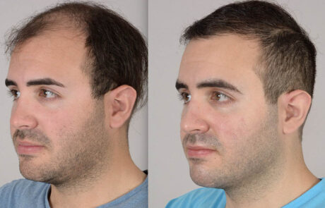 Male Hair Transplant Before & After