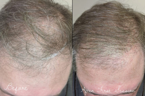 scalp micropigmentation before and after