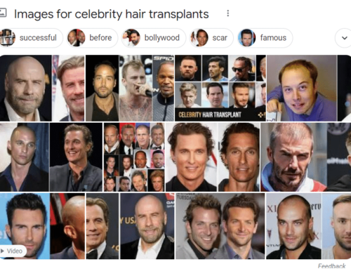Celebrity Hair Transplants