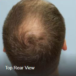 top of head view hair transplant photo